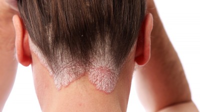 Head Injuries, Psoriasis